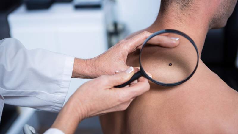 skin cancer