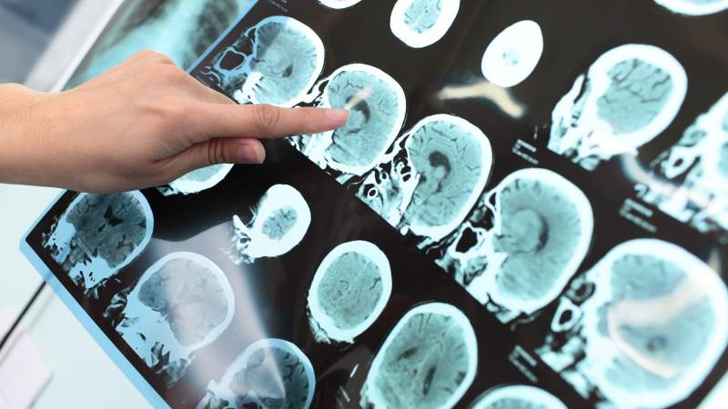 Alzheimer's Disease Stages and Treatments