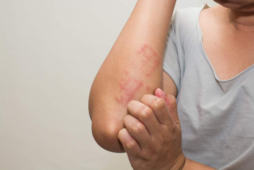 Everything You Need To Know About Eczema Healthversed